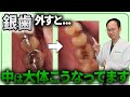 昔に銀歯治療された方は見た方がいいかも...銀歯の詰め物を外すと大体こんなことになっています...