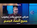 Boualshahm Yaqub Chronic Rheumatoid Arthritis Can Affect All Organs Of The Body Including The 