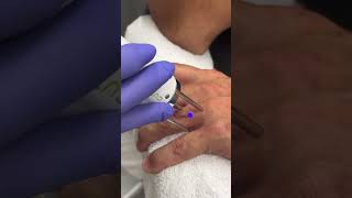 Tattoo Removal at Ixchel Skin and Body Medical Spa