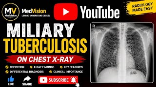 Miliary Tuberculosis on Chest X-ray Explained | Miliary TB Radiology | Chest X-ray Interpretation.