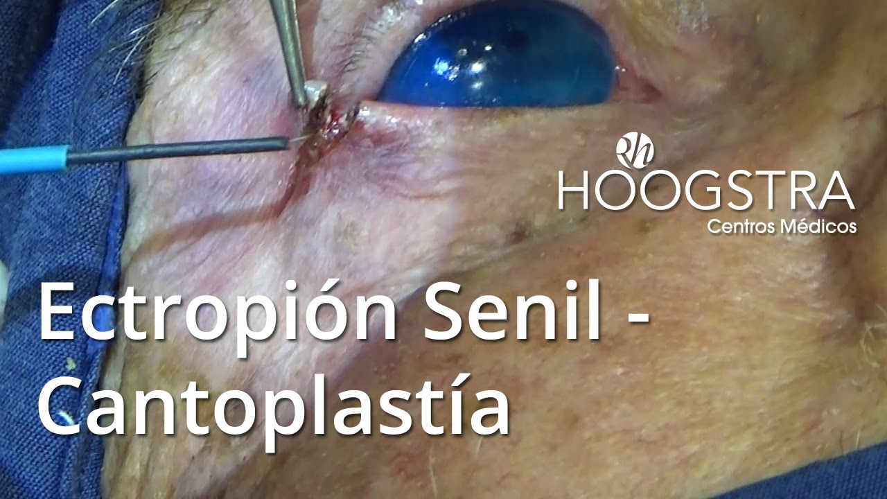 ultrasonido portatil Ectropión Senil - Cantoplastía (16012)