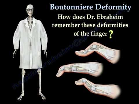 Boutonniere Deformity - Everything You Need To Know - Dr. Nabil Ebraheim