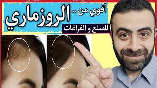 بديل اقوي من تونر الروزماري ( اكليل الجبل )  لعلاج الصلع و تساقط الشعر و يزيد التركيز و الطاقة