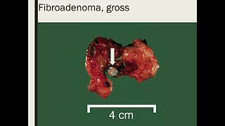 stromal neoplasms