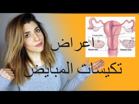 تكيس المبايض (اسباب ظهوره و اعراضه )