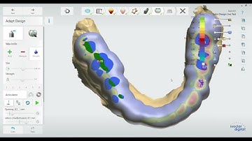 Night Guard Design with KeyStone KeySplint Hard Clear - Splint Studio Test
