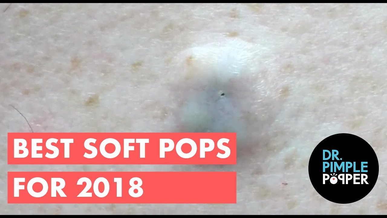 The Best Of Softpops 2015 For 2018 Dr Pimple Popper Youtube