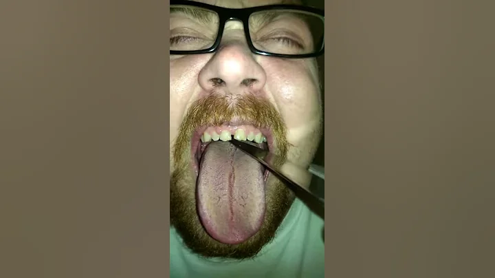 Tonsils