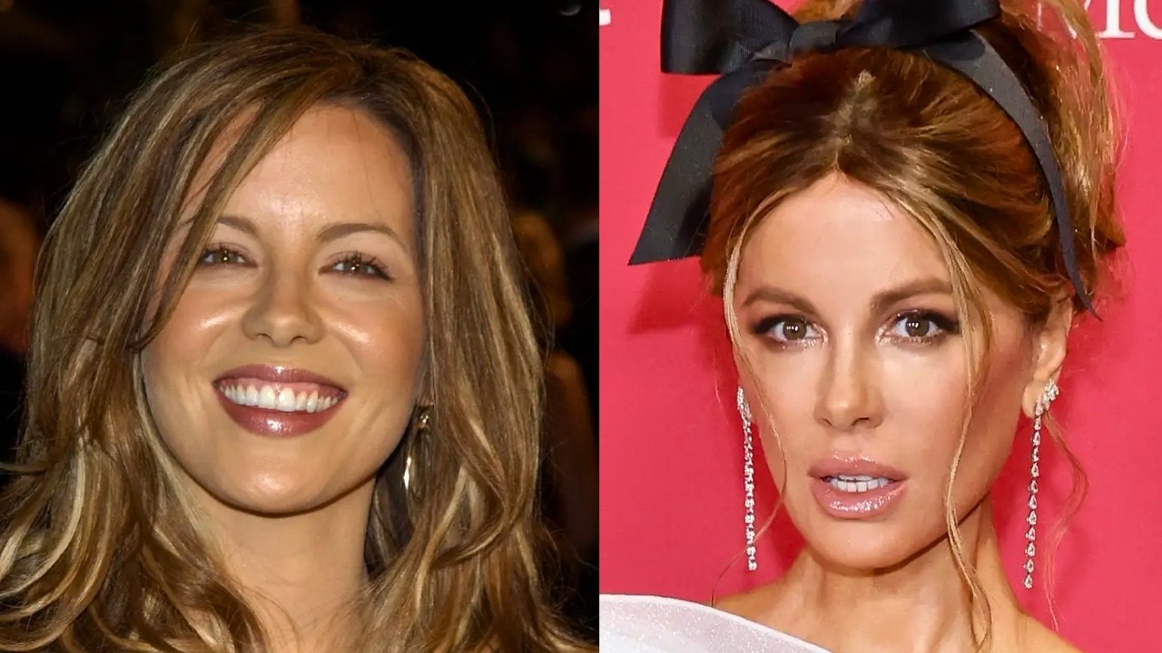Celebrities Who've Finally Admitted to Plastic Surgery in 2025 YouTube