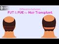 Difference between fut and fue technique of hair transplant  dr suvina attavar