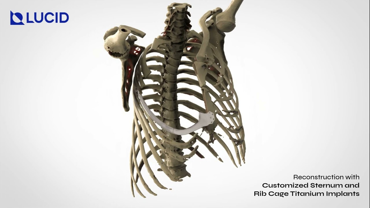 Titanium Rib Support Rib Implants Rib Cartilage Rhinoplasty: Pros And Cons | Miami, FL
