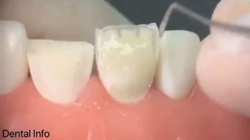 Class 4 Direct Composite Restoration (Step By Step)