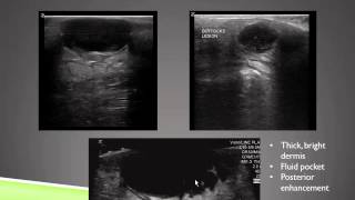 Ultrasound of Skin and Soft Tissue Infections screenshot 5