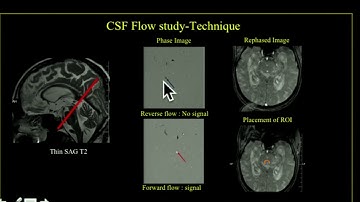 TMT: CSF Flow Studies Part IV: Normal Pressure Hydrocephalus