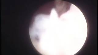 Hysterscopy large polyp and small one