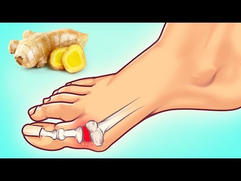 10 Экспертных Советов по Борьбе с Приступами Подагры