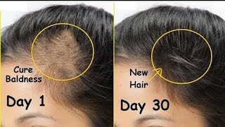 إعادة نمو الشعر الجديد خلال30 يوما وعلاج الصلع | عصير البصل والثوم لنمو الشعر الكثيف