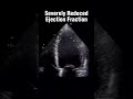Normal Ejection Fraction vs Abnormal Ejection Fraction