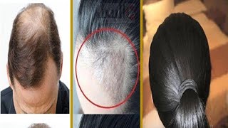وصفة طبيعية لعلاج تساقط الشعر بالاعشاب 0657890401