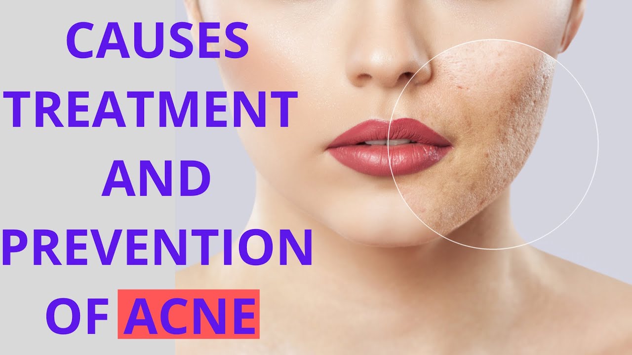 CAUSES | TREATMENT | PREVENTION OF ACNE(Isotretinoin,Corticosteroid,Salicylic acid,Resorcinol)