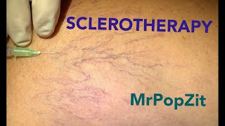 Common procedure I perform. Sclerotherapy collapses small vessels and reduces the red appearance