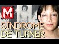 El SÍNDROME de TURNER 🙍‍♀️🤷‍♀️