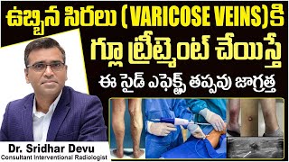 గ్లూ ట్రీట్మెంట్ సైడ్ ఎఫెక్ట్స్ || Side Effects of Super Glue Treatment for Varicose Veins | Dr Devu