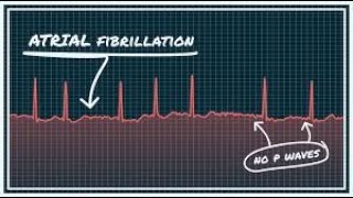 Atrial FIbrillation  ( A F ) part 1