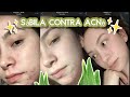 COMO CURAR EL ACNÉ  | SABILA PARA EL ACNE  | Diana DLH