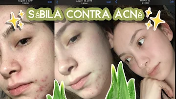 ¿Es bueno el aloe vera para el acné?