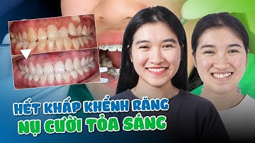 NIỀNG RĂNG KHẤP KHỂNH GIÚP MÌNH THAY ĐỔI NỤ CƯỜI NHƯ THẾ NÀO?