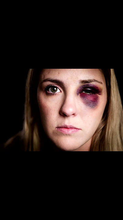 The most common eye injuries - Black eye