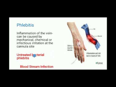 Video: Apa penyebab flebitis uk?