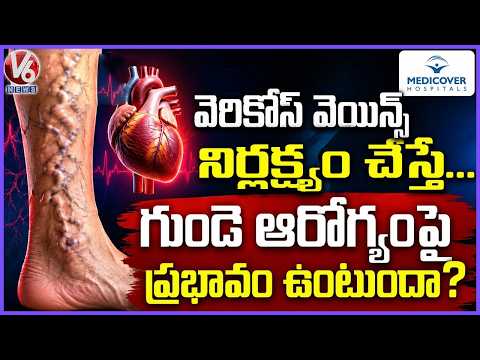 Good Health :  If Varicose Veins Are Neglected.. Does It Affect Heart..? | Medicover Hospitals | V6 - V6NEWSTELUGU