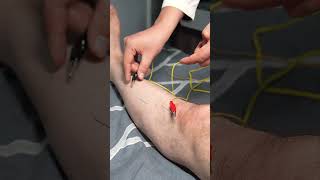 ‼️ IGNA BILAN DAVOLASH?