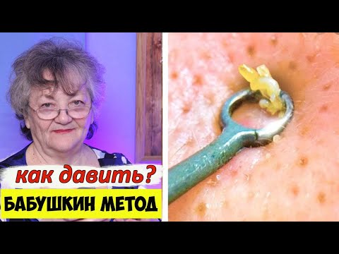Как давить прыщи на лице - бабушкин метод