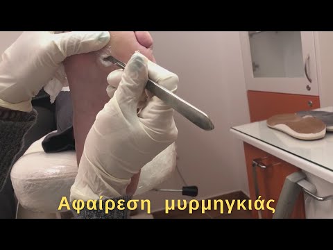 ΑΝΤΙΜΕΤΩΠΙΣΗ ΜΥΡΜΗΓΚΙΑΣ | TREATMENT FOR PLANTAR WARTS