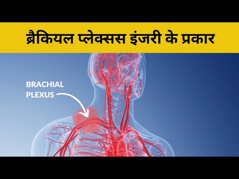 वीडियो: क्या प्लेक्सस सिरदर्द का कारण बन सकता है?