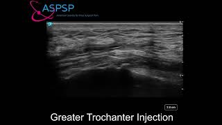 Ultrasound Guided Greater Trochanteric Bursa Injection