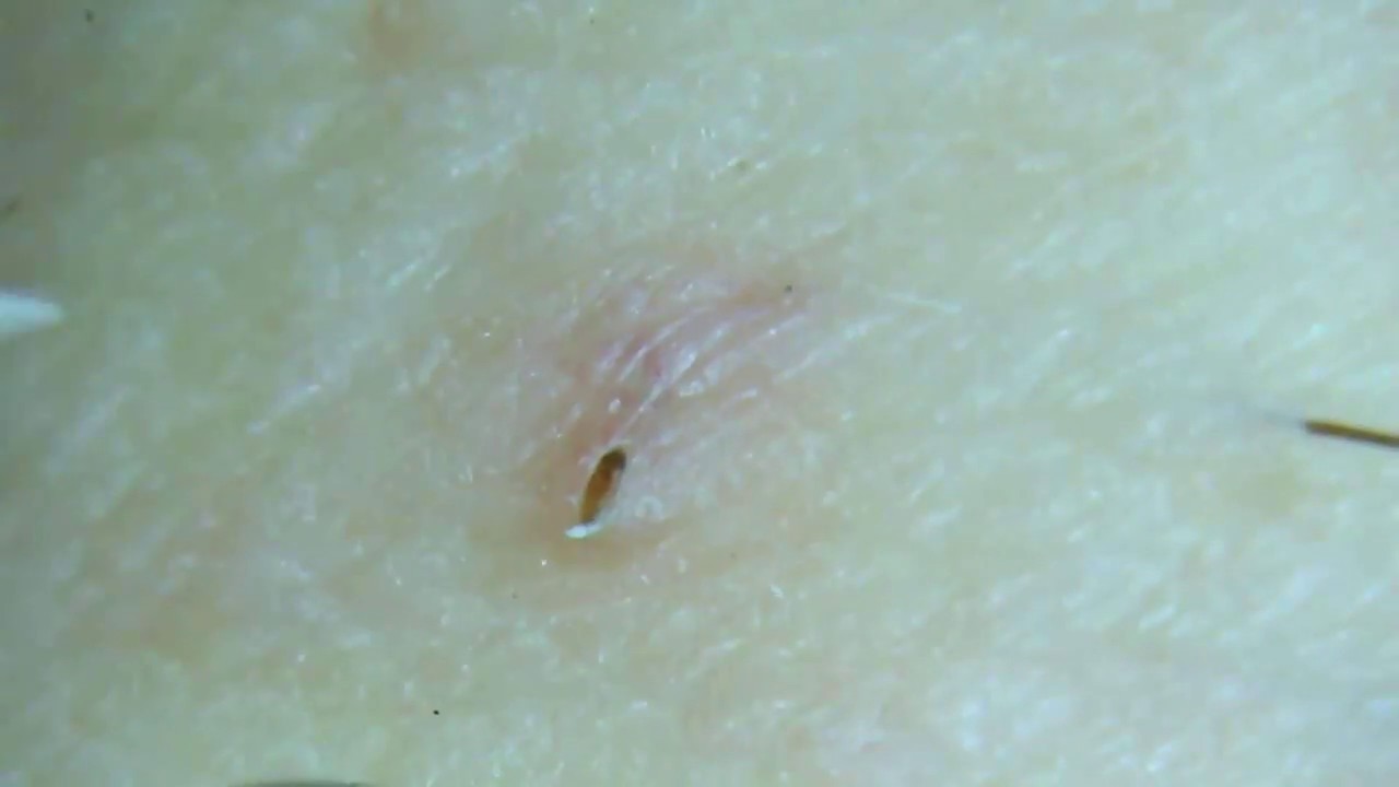 Gross Removing An Ingrown Pubic Hair Youtube