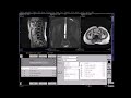Magnetic Resonance Imaging MRI Of The Lumbar Spine From Data Recording To Film Printing 