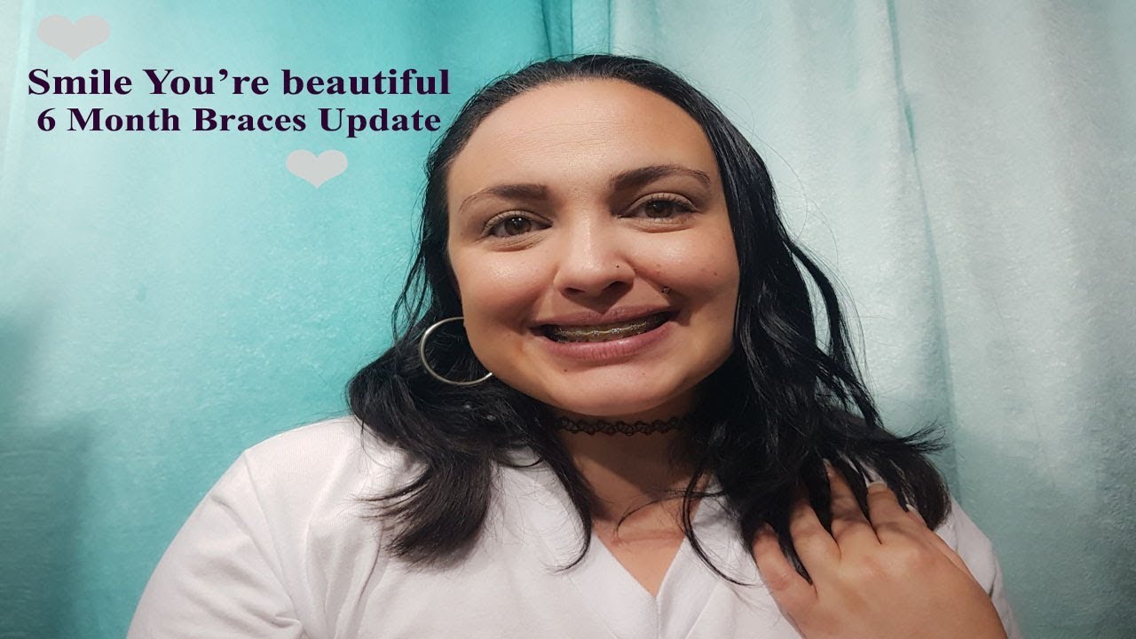 Braces 6 Month Adjustment Update YouTube