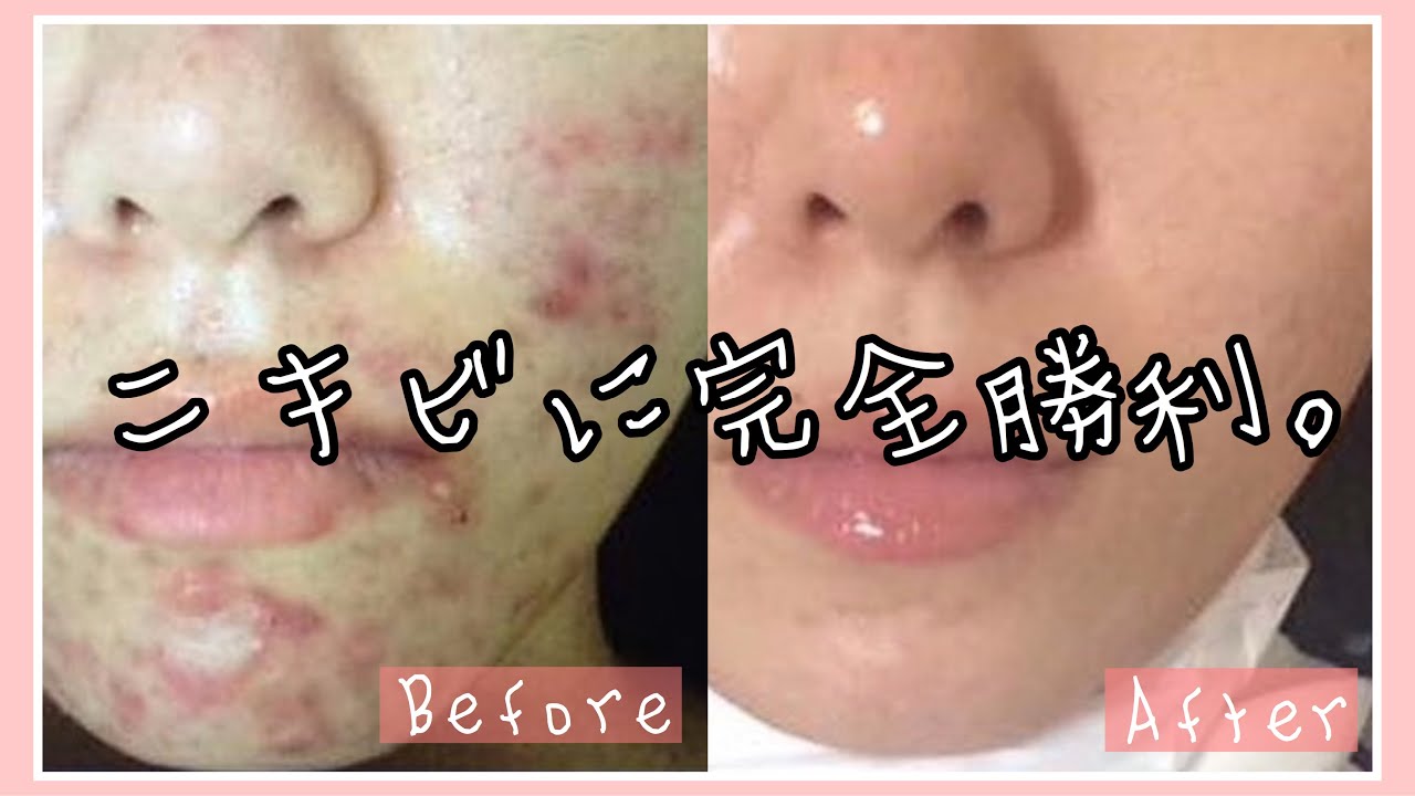 ニキビを治す方法 Olのニキビ全滅までの道のり 肌荒れ改善 スキンケア 美肌 色素沈着 ニキビ跡 生活習慣 Youtube