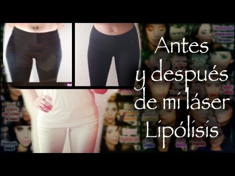 Acido hialuronico surcos nasogenianos antes y despues de adelgazar