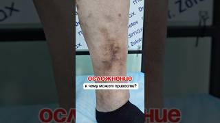 @flebolog вот, что будет если не лечить варикоз на начальных стадиях…#флебологзолотов #варикозног