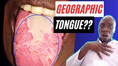 What is a Geographic Tongue? | Benign Migratory Glossitis| Treatment for a Geographic Tongue