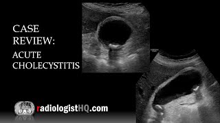 Ultrasound of Acute Cholecystitis