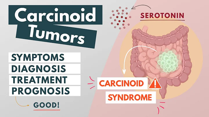 Carcinoid Tumor | Visual Explanation | Symptoms, diagnosis, treatment, prognosis