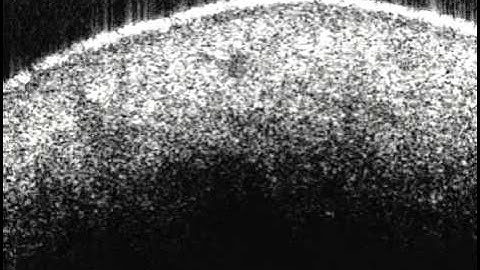 Three-Dimensional Images and Vessel Rendering Using Optical Coherence Tomography 2