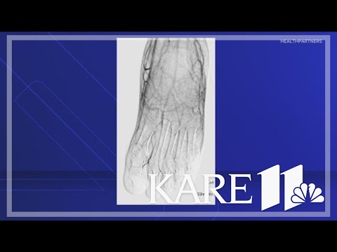 FDA approves first frostbite treatment
